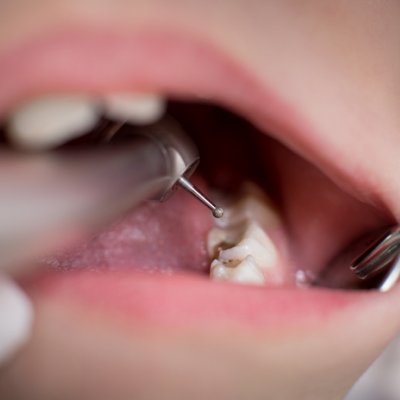 Open child's mouth with dental equipment visible inside 